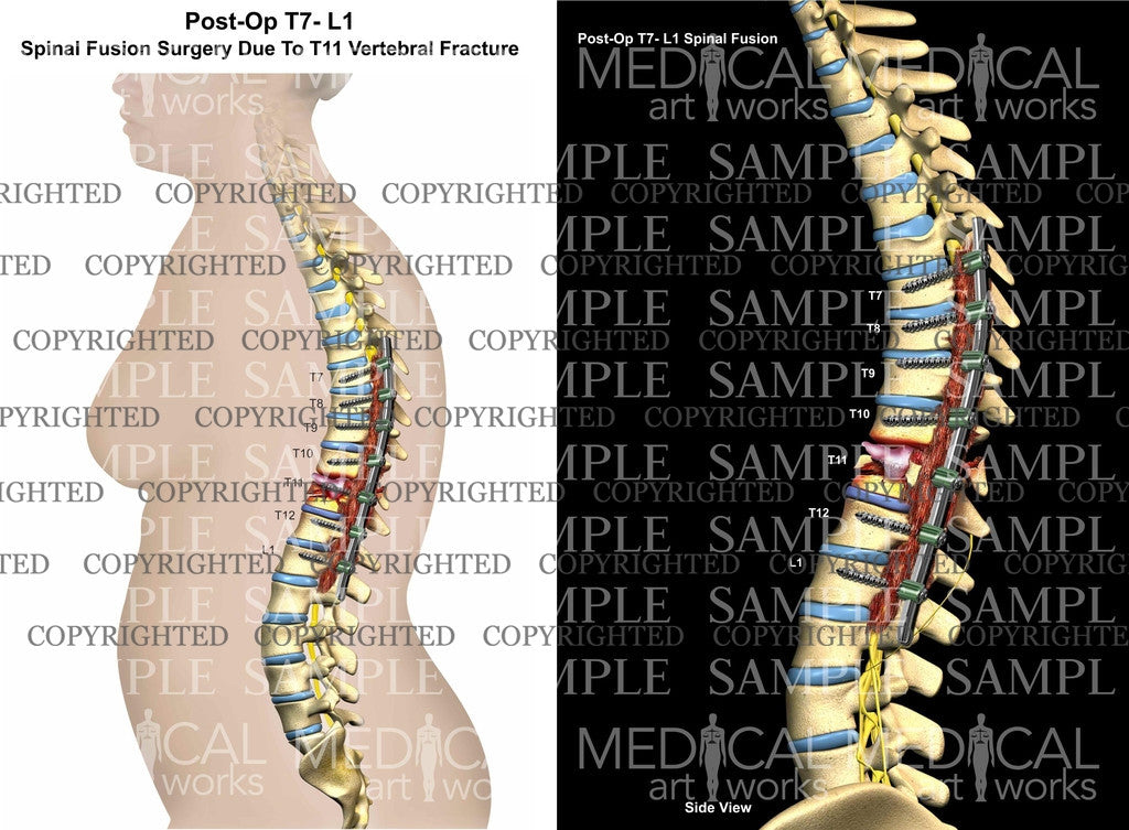 Posterolateral Spinal Fusion lateral