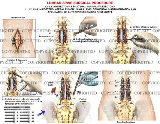 4 Level - Posterior lumbar interbody fusion