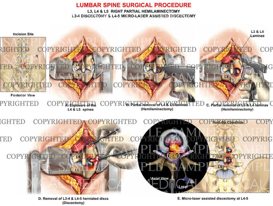 Lumbar spine hemilaminectomy