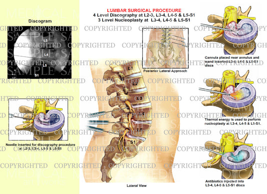 Lumbar surgical procedure discography nucleoplasty