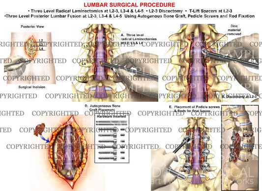 3 Level - L2-3, L3-4 and L4-5  Posterior lumbar laminectomies