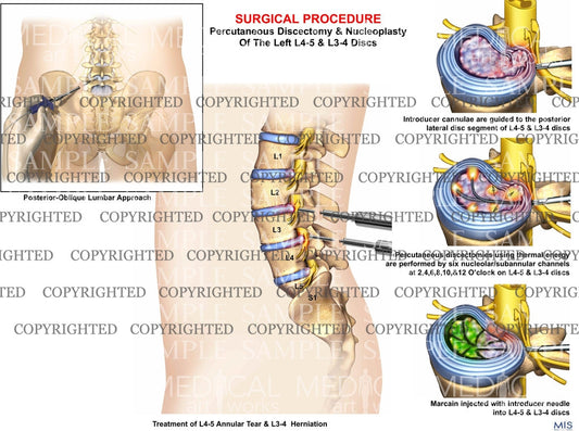 L2-3 & L3-4 - Lumbar Spine discectomy and nucleoplasty