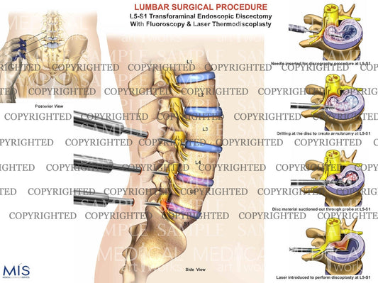 Lumbar spine endoscopic discectomy