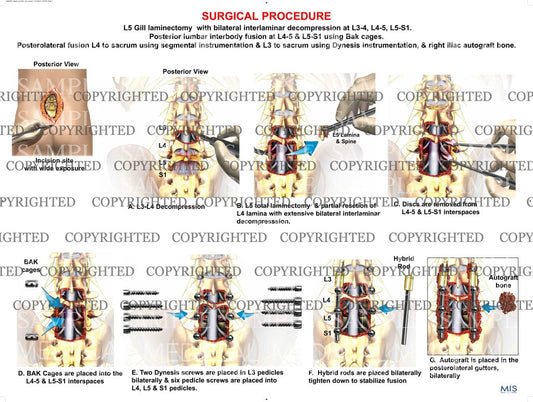 Lumbar spine decompression laminectomy