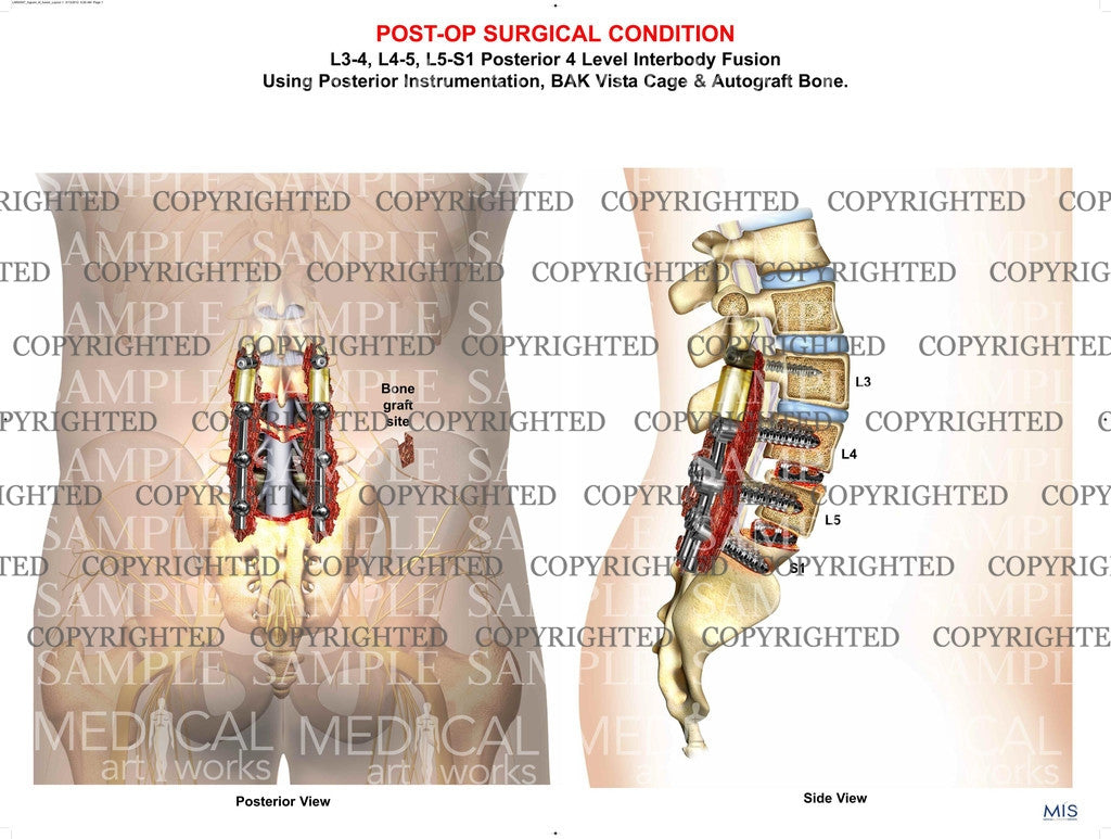 Lumbar Spine Decompression laminectomy post-op