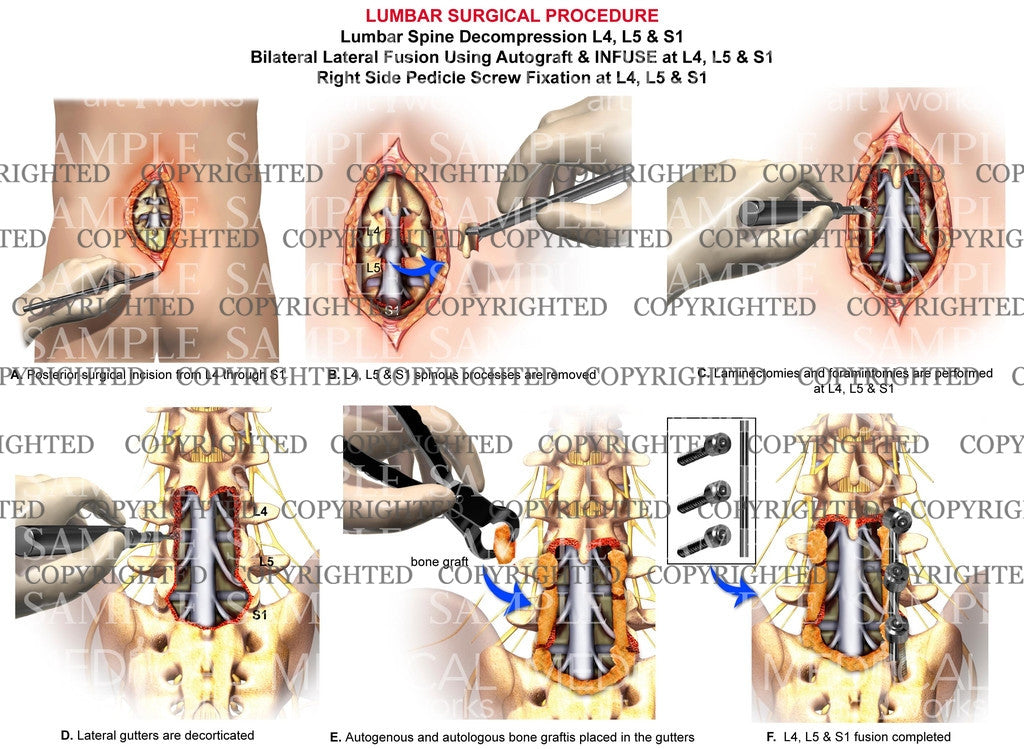 3 Level - Lumbar spine lateral fusion - decompression