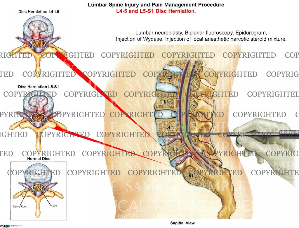 Lumbar Spine Injury and Pain Management Procedure