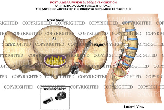 S1 Post operavite lumbar fusion condition