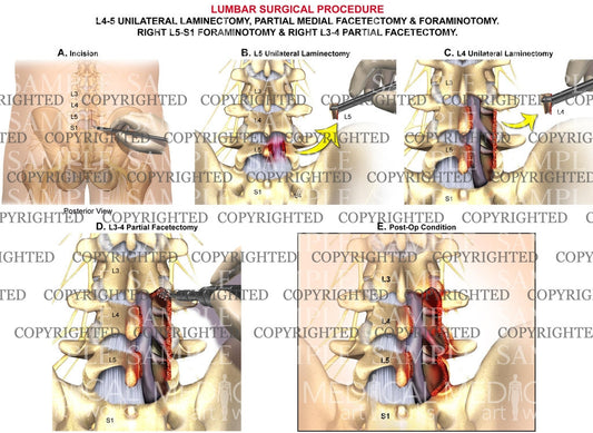 Lumbar unilateral laminectomy