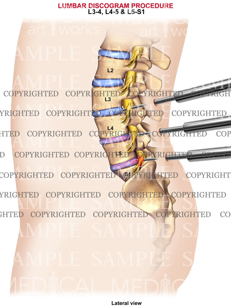 Discogram Meaning 3 Level - Lumbar discogram procedure – Medical Art Works