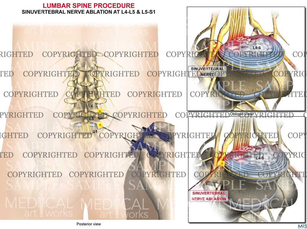 Lumbar nerve surgical procedure