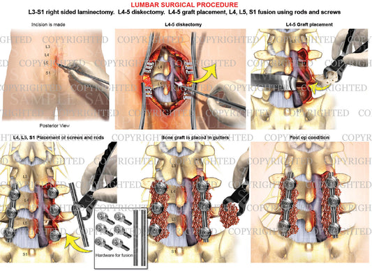 2 Level - Posterior lumbar interbody fusion surgery