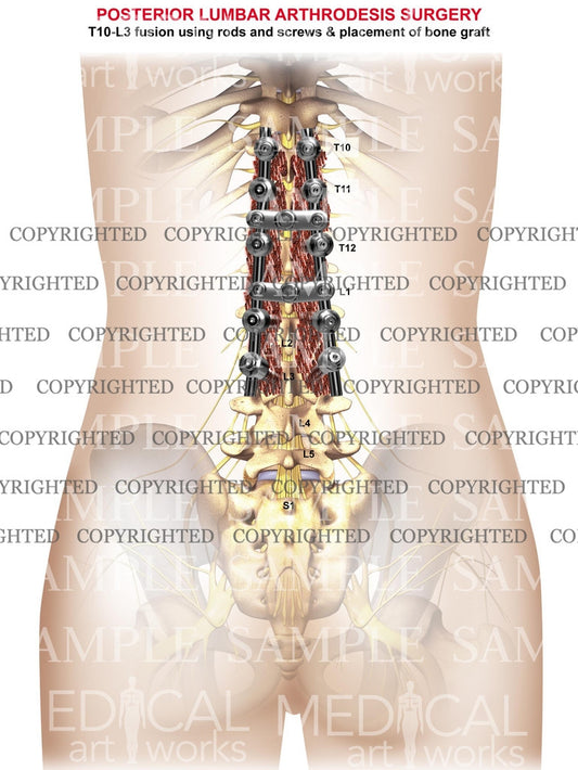 4 level - Lumbar posterior arthrodesis surgery