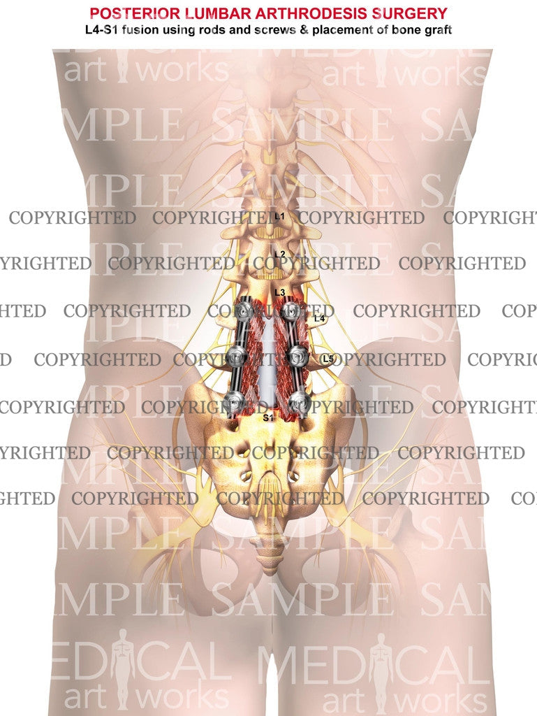 2 level - Lumbar posterior arthrodesis surgery