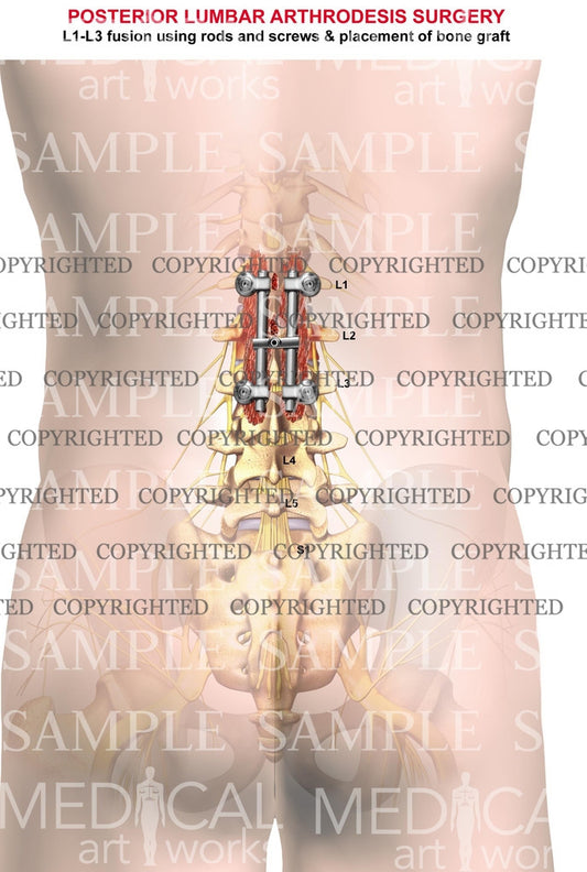 2 level - Lumbar posterior arthrodesis surgery