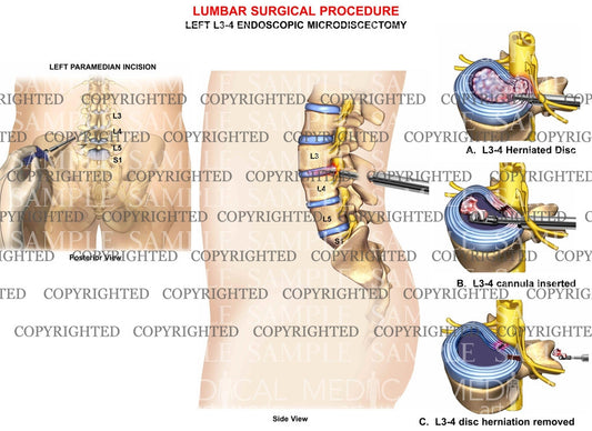 1 level - L3-4  Left endoscopic microdiscectomy