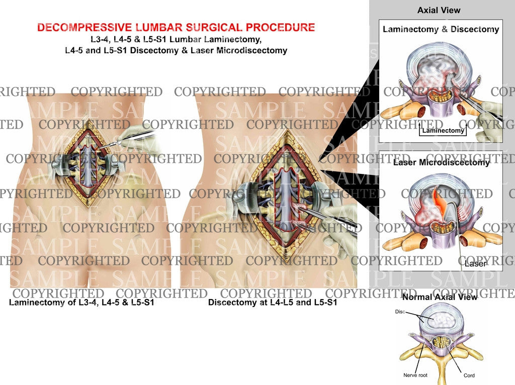Decompressive lumbar Surgical Procedure