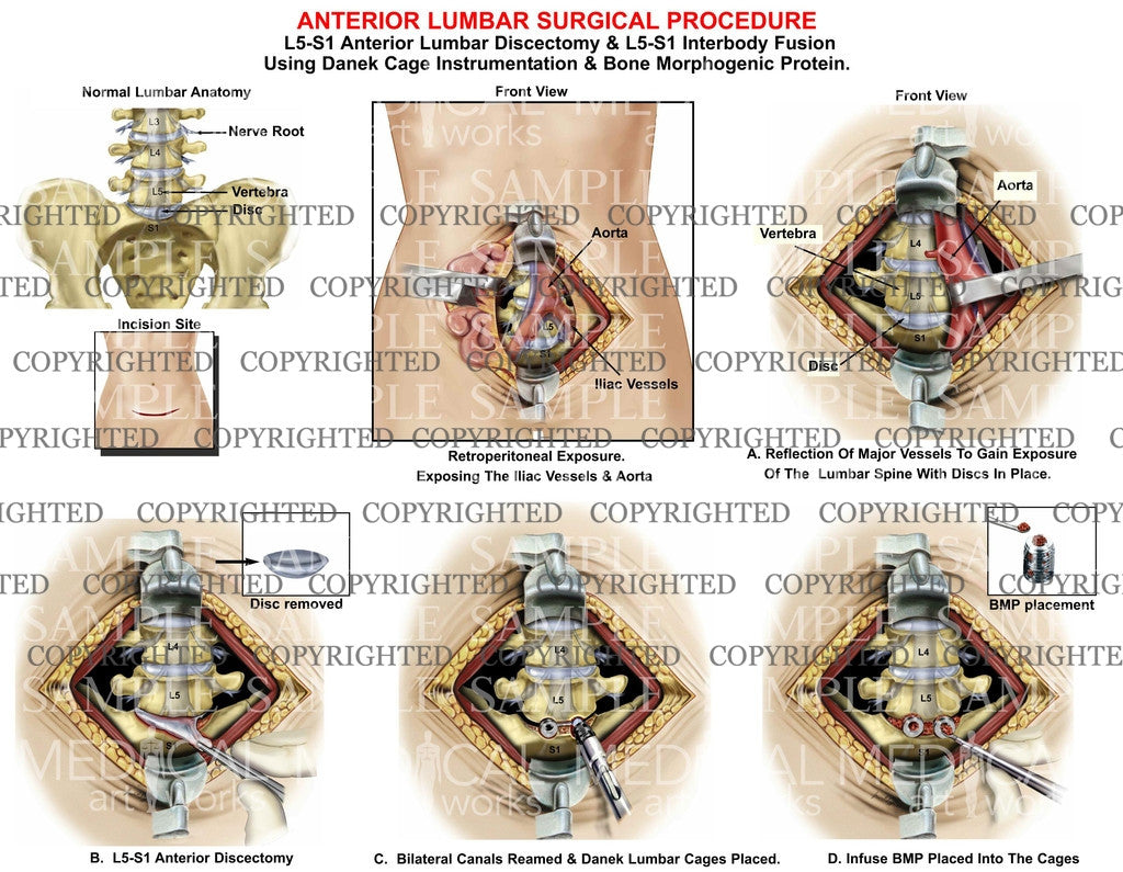 Anterior lumbar surgical procedure L5-S1