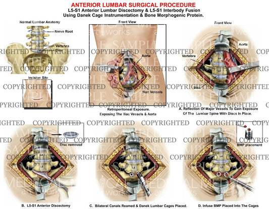 Anterior lumbar surgical procedure