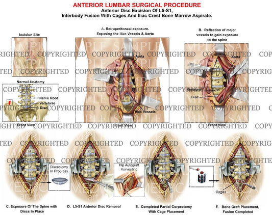 1 Level - L5-S1 Anterior lumbar interbody fusion surgery