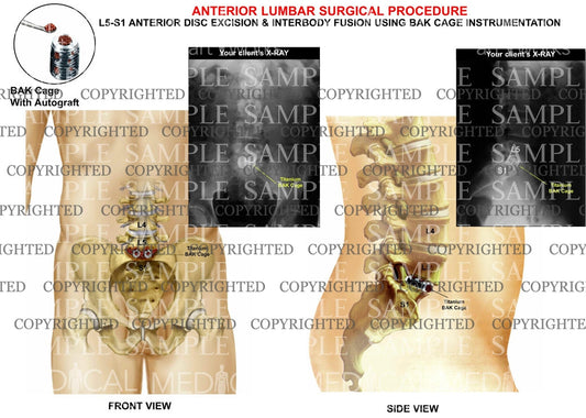 Post operative condition of lumbar surgical replacement with x-rays