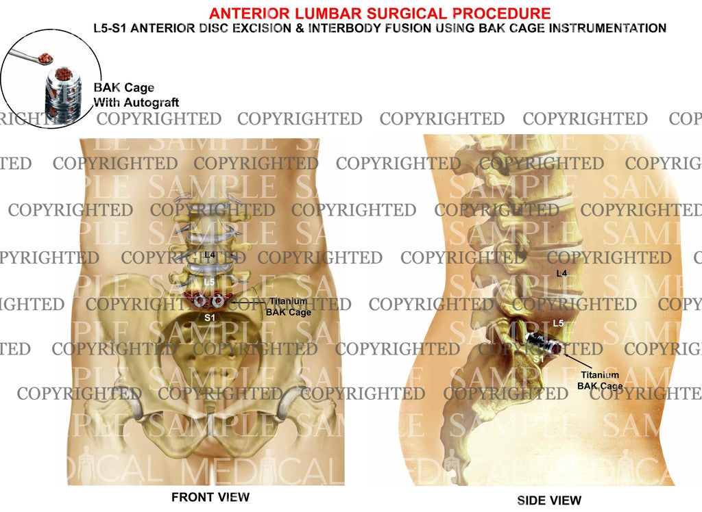 L5-S1 Anterior lumbar interbody fusion and discectomy