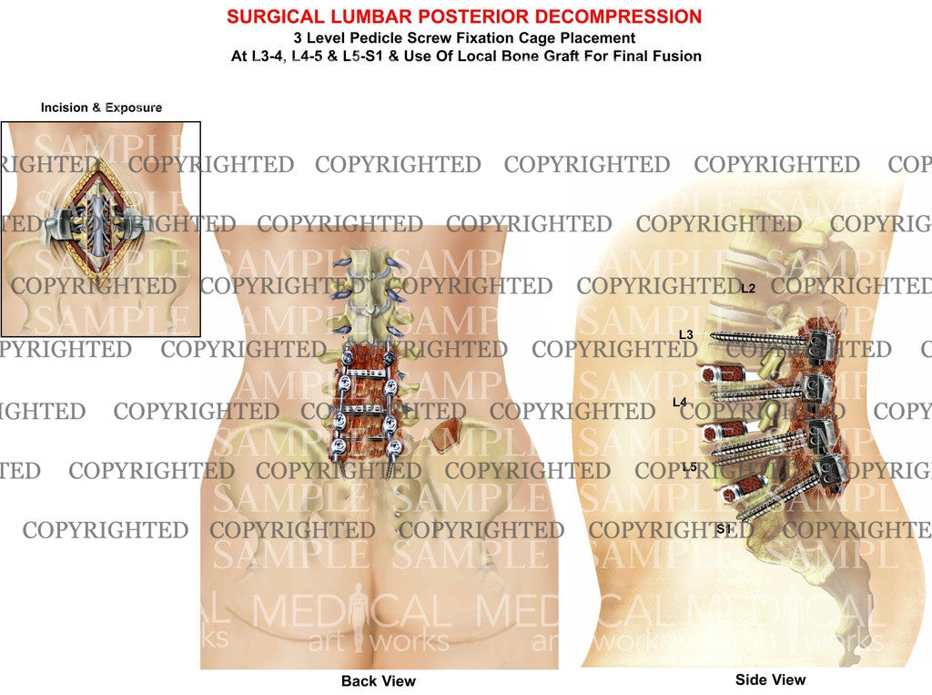 Surgical lumbar Posterior Decompression