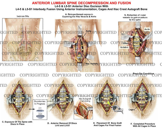 2 Level - Anterior lumbar interbody fusion and decompression