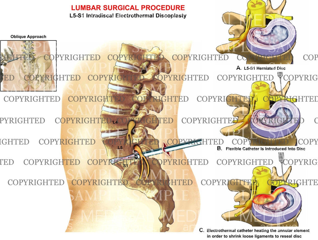 Lumbar spine Intradiscal electrothermal discoplasty