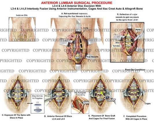 2 Level - L3-4 & L4-5 Anterior lumbar interbody fusion surgery