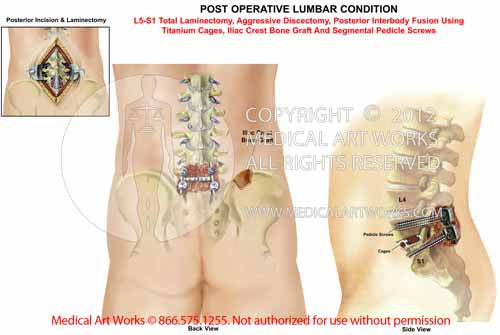 1 level - Lumbar posterior surgical procedure