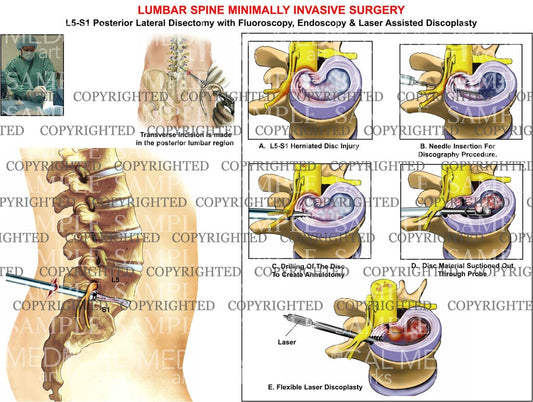 L5-S1 Lumbar posterior minimally invasive surgery