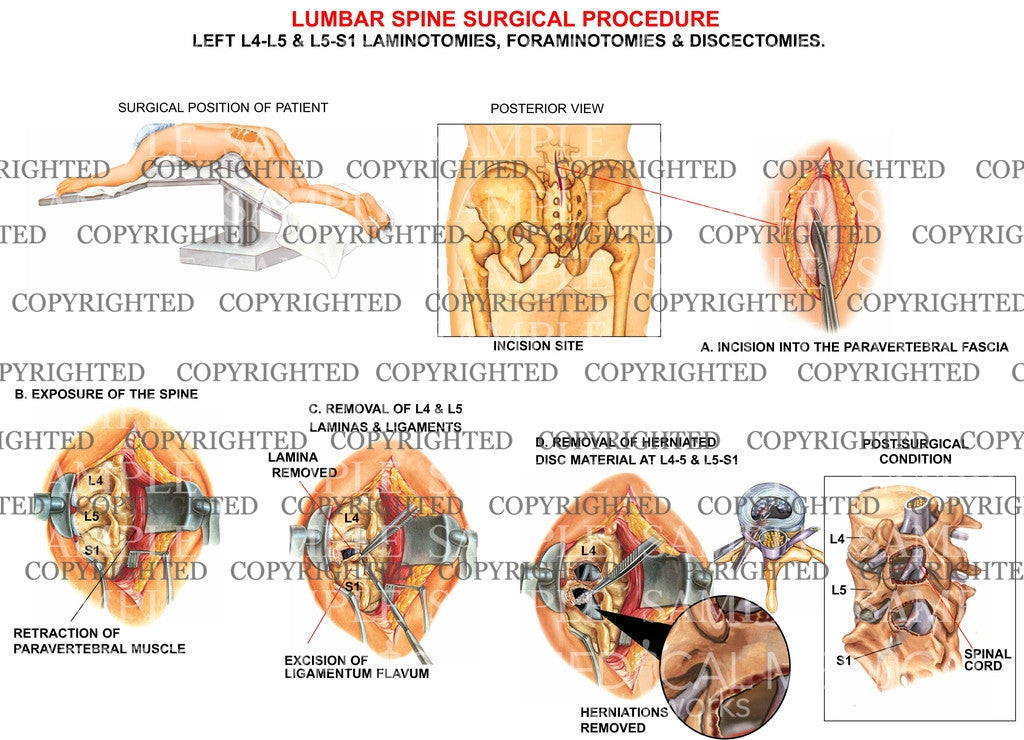 2 level - Left sided lumbar surgery
