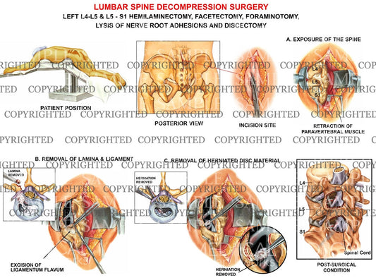 L4-5, L5-S1 Lumbar spine decompression surgery