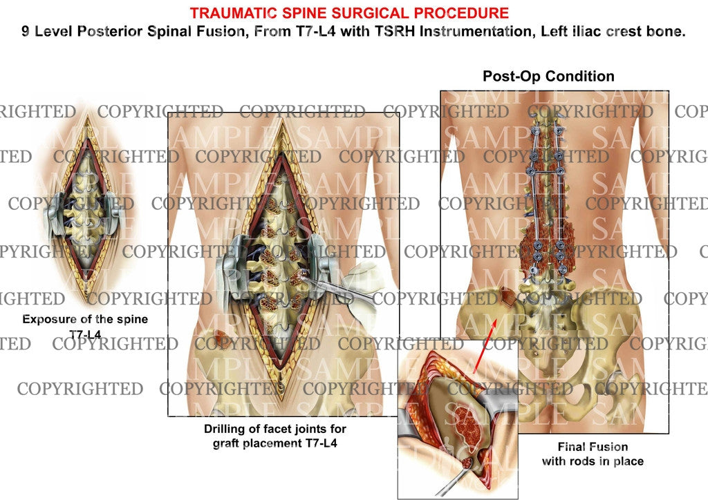 9 Level  - T7-L4  Posterior lumbar spinal fusion