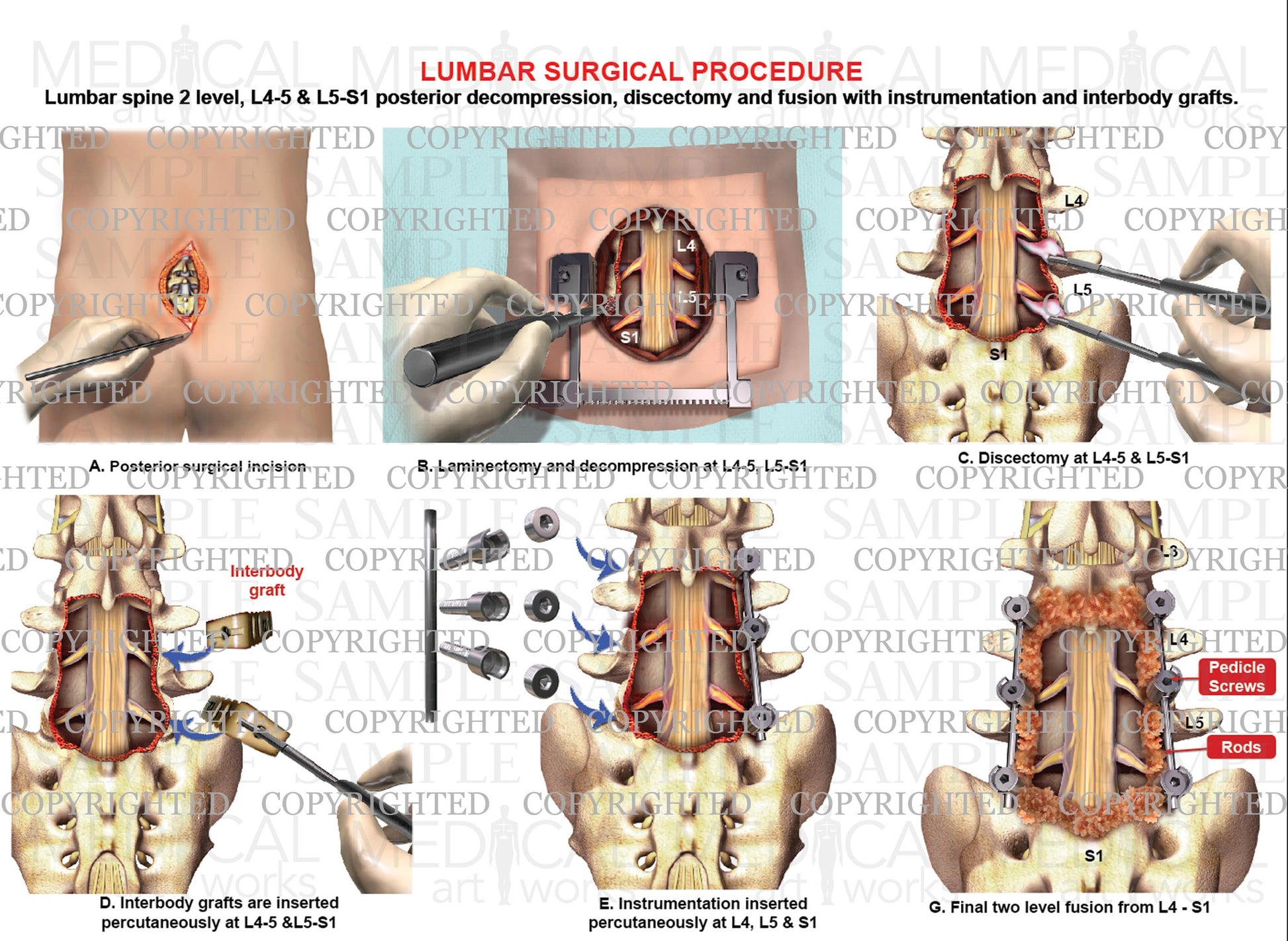 2 Level L4 L5 S1 Posterior Lumbar Interbody Fusion Decompression 2-level-l4-l5-s1-posterior-lumbar-interbody-fusion-decompression