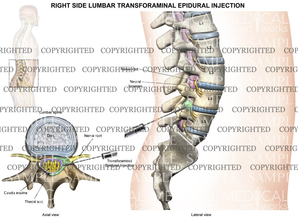 Intraforaminal Injection L4-5 Right side lumbar transforaminal epidural injection - Male ...