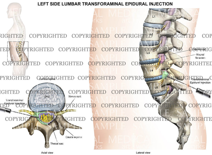 L4-5 Lumbar transforaminal epidural injection - Female – Medical Art Works