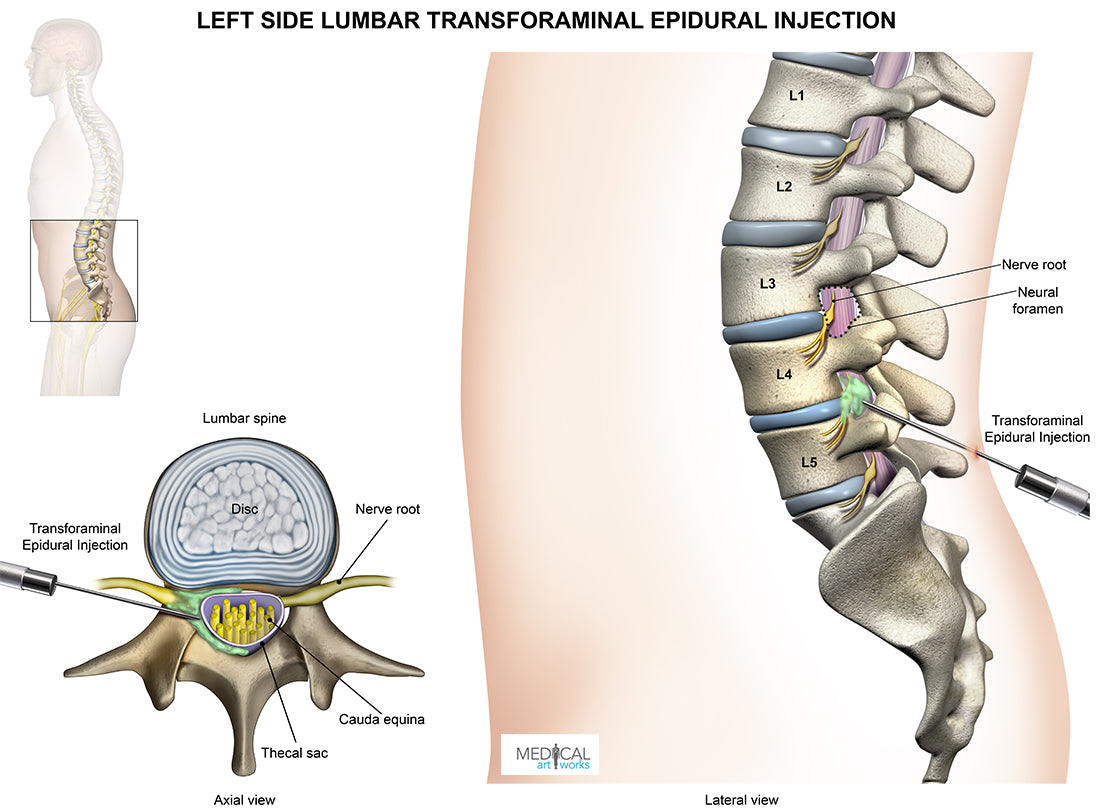 L4-5 Lumbar transforaminal epidural injection - Male