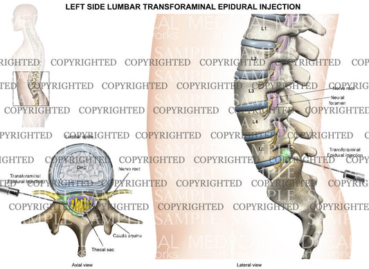 L5-S1 Lumbar transforaminal epidural Injection - left side - female