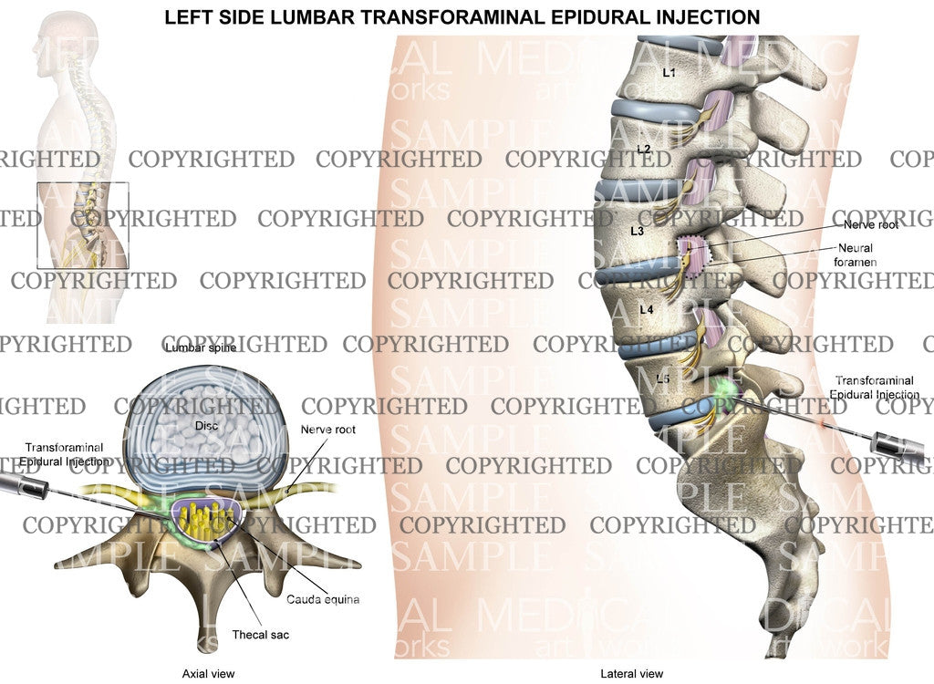 L5-S1 Left side lumbar transforaminal epidural injection - Male