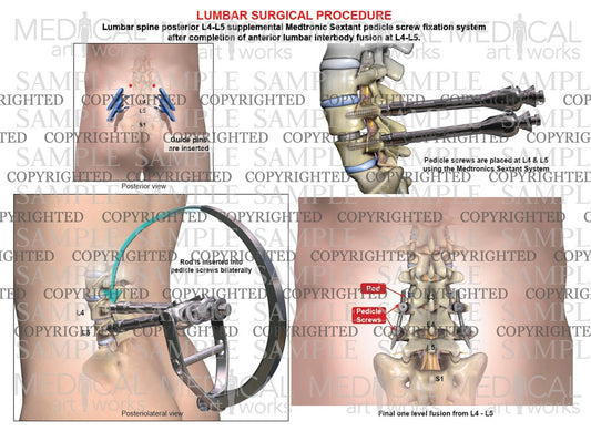 L4-5 Posterior lumbar interbody fusion - medtronics sextant system - male