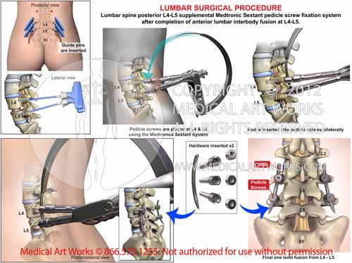 1 Level - L4-5 Posterior lumbar interbody fusion - medtronics sextant system - female