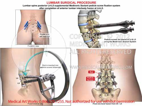 L4-5 Posterior lumbar interbody fusion - sextant system - Female
