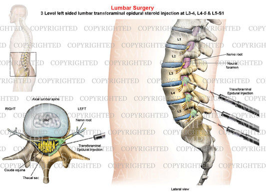 3 Level - Left-side lumbar Transforaminal Epidural Injection - Male