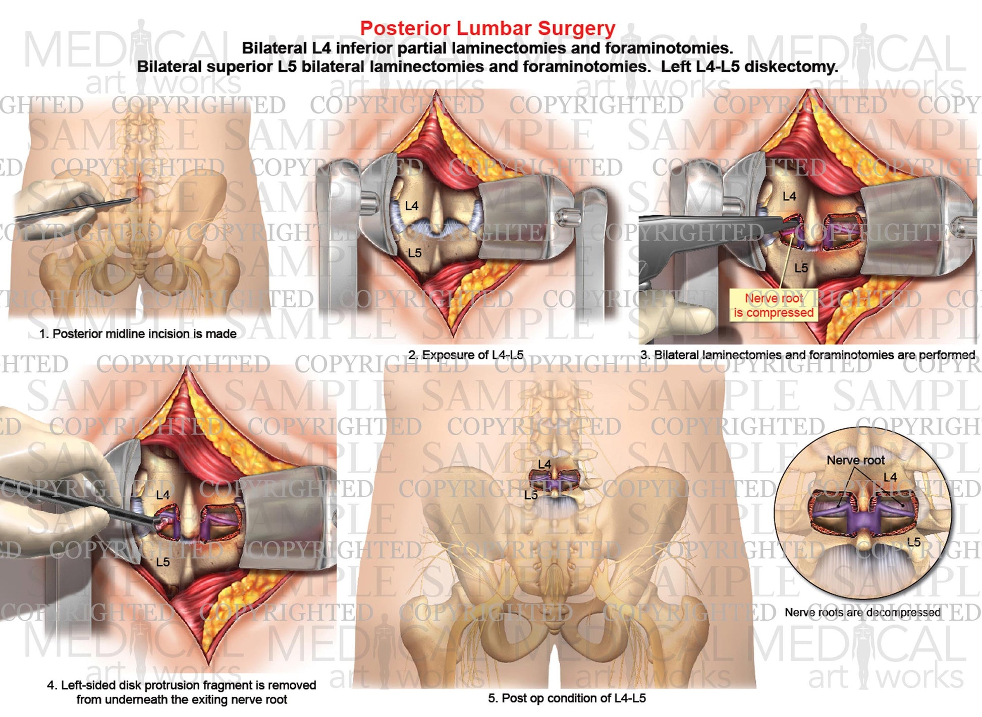 1 Level - L4-L5 Lumbar spine bilateral laminectomies - Foraminotomies - Diskectomy