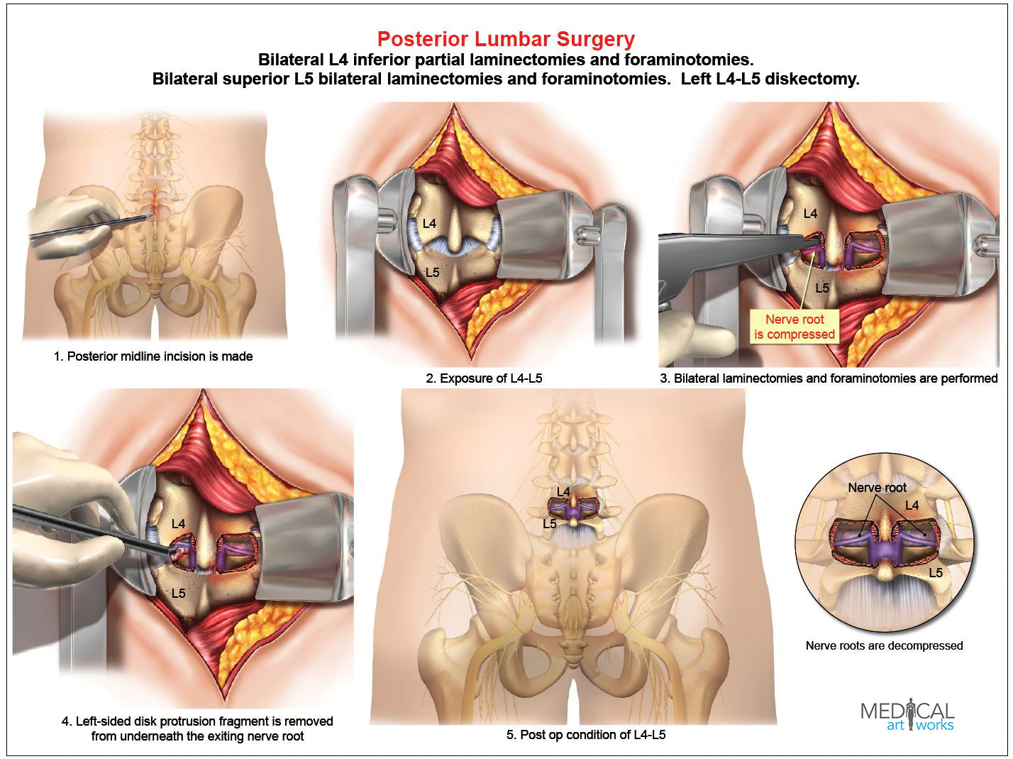 1 Level - L4-L5 Lumbar spine bilateral laminectomies - Foraminotomies - Diskectomy