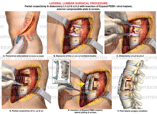 2 level - Lumbar lateral surgical procedure and fusion