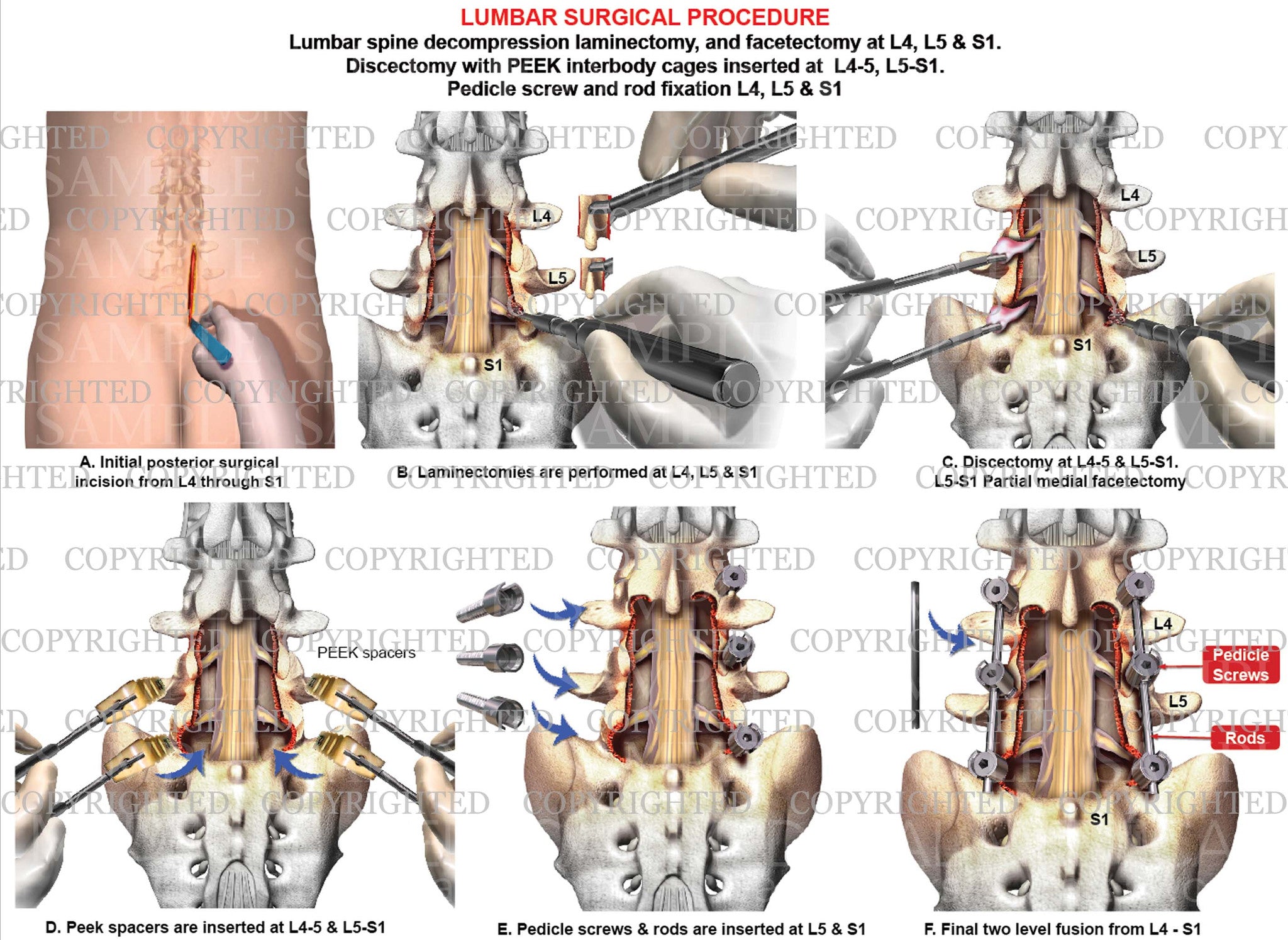 Lumbar Instrumentation 2 level - Lumbar spine fusion with instrumentation L4-5 and L5-S1 disc ...