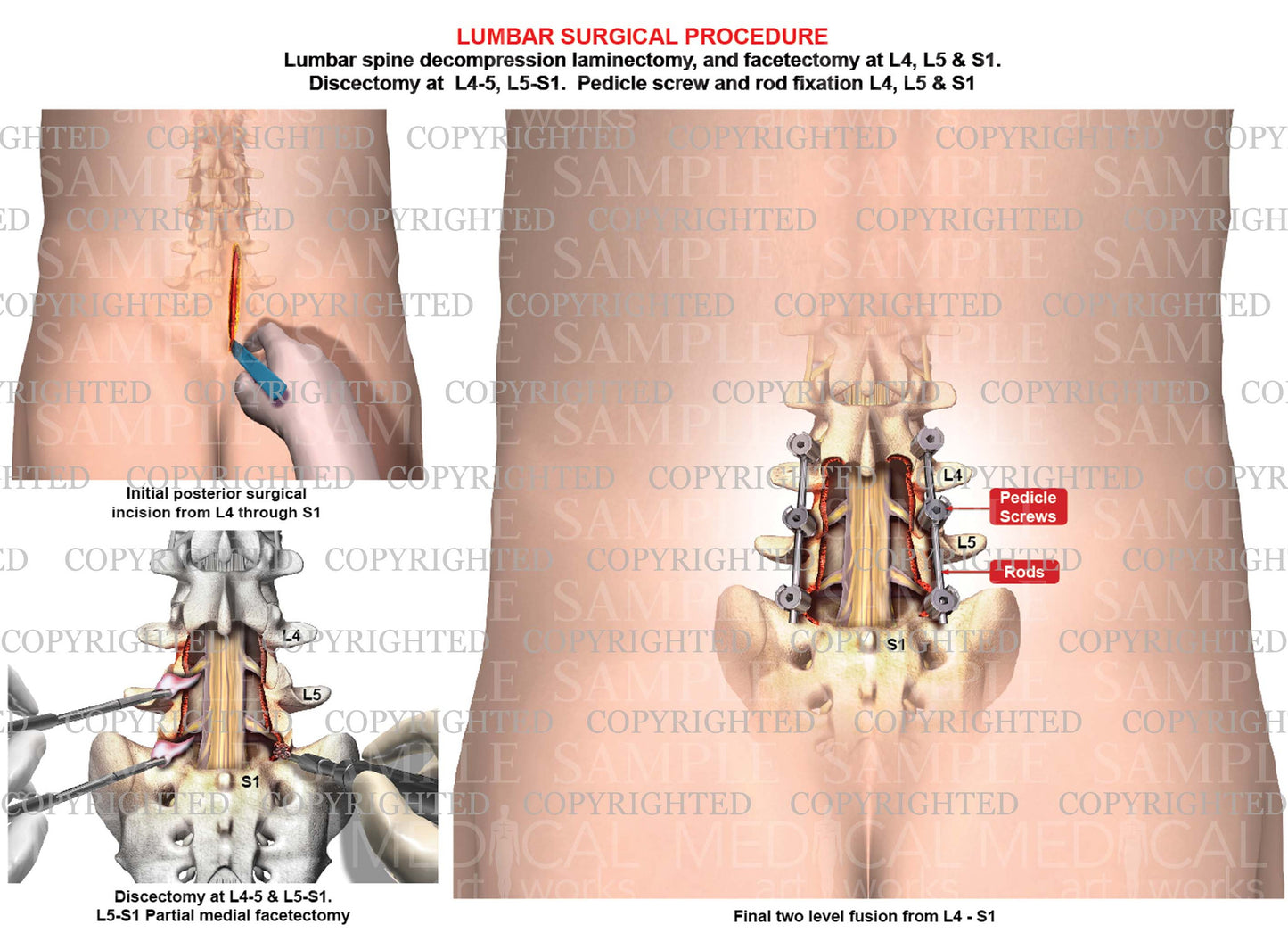 2 level - L4-5 & L5-S1 Lumbar spine fusion - discectomies